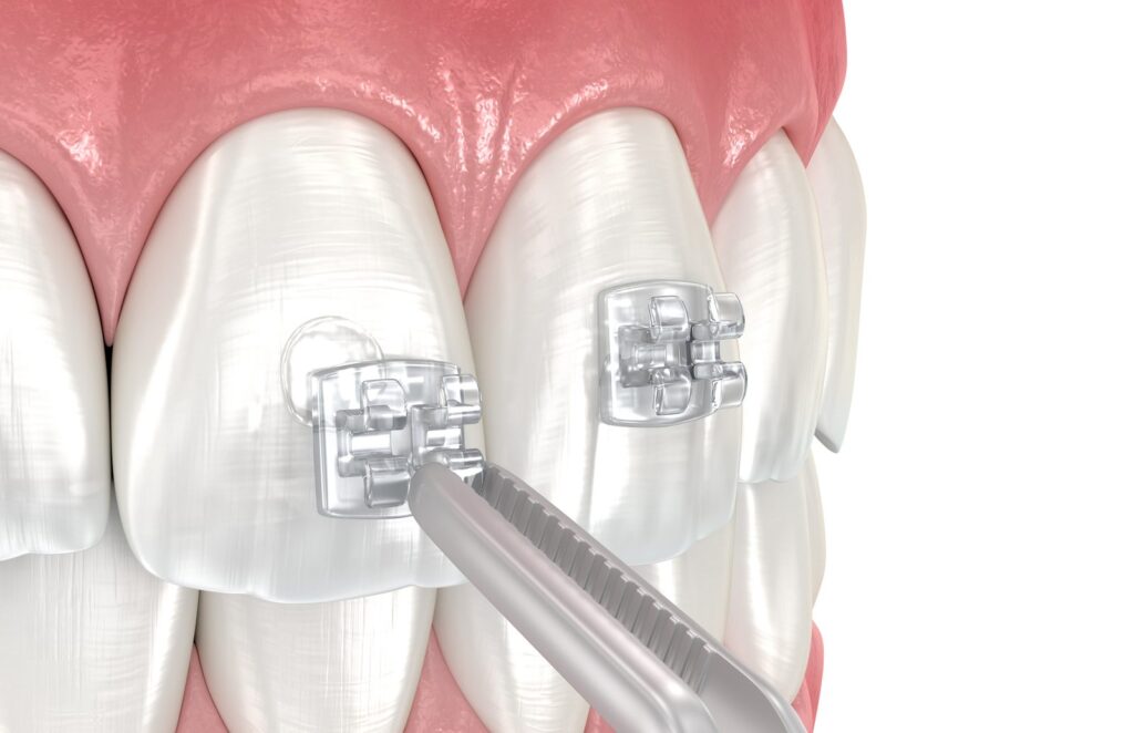3D illustration of a tooth-coloured ceramic bracket being placed on a tooth